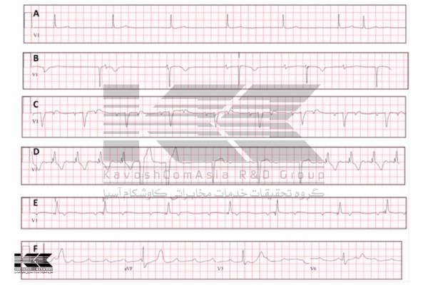 نوار قلب یا الکتروکاردیوگرام چیست