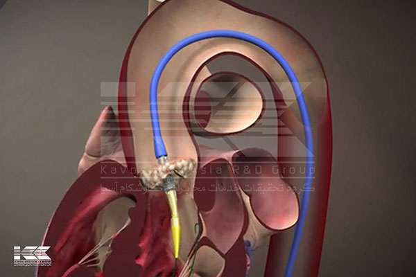 تعویض و ترمیم دریچه میترال با روش TAVR